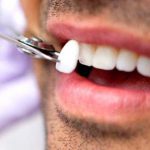 ¿Sabes qué son las carillas dentales? una pista, sonrisas de cine