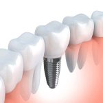 Implantes dentales – ¿Qué debes saber?