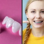Ortodoncia o carillas dentales, descubre cuál es la mejor opción para ti