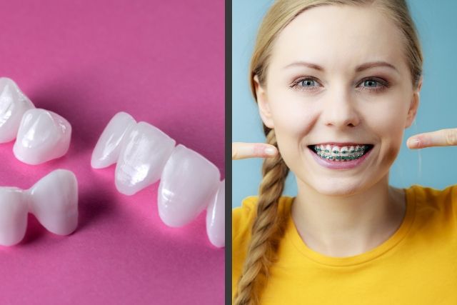 ortodoncia o carillas dentales