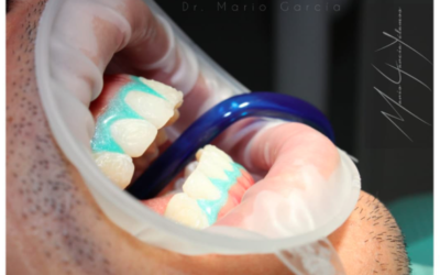 ¿Cuál es el mejor tratamiento de blanqueamiento dental para tus dientes?